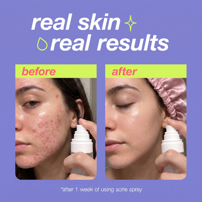 KClear ™  Acne Spray